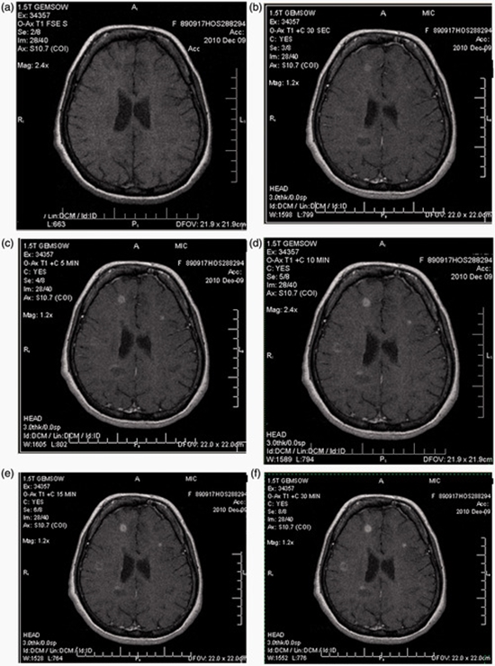  diagnosis of novel or relapsing multiple sclerosis (MS) {faces}